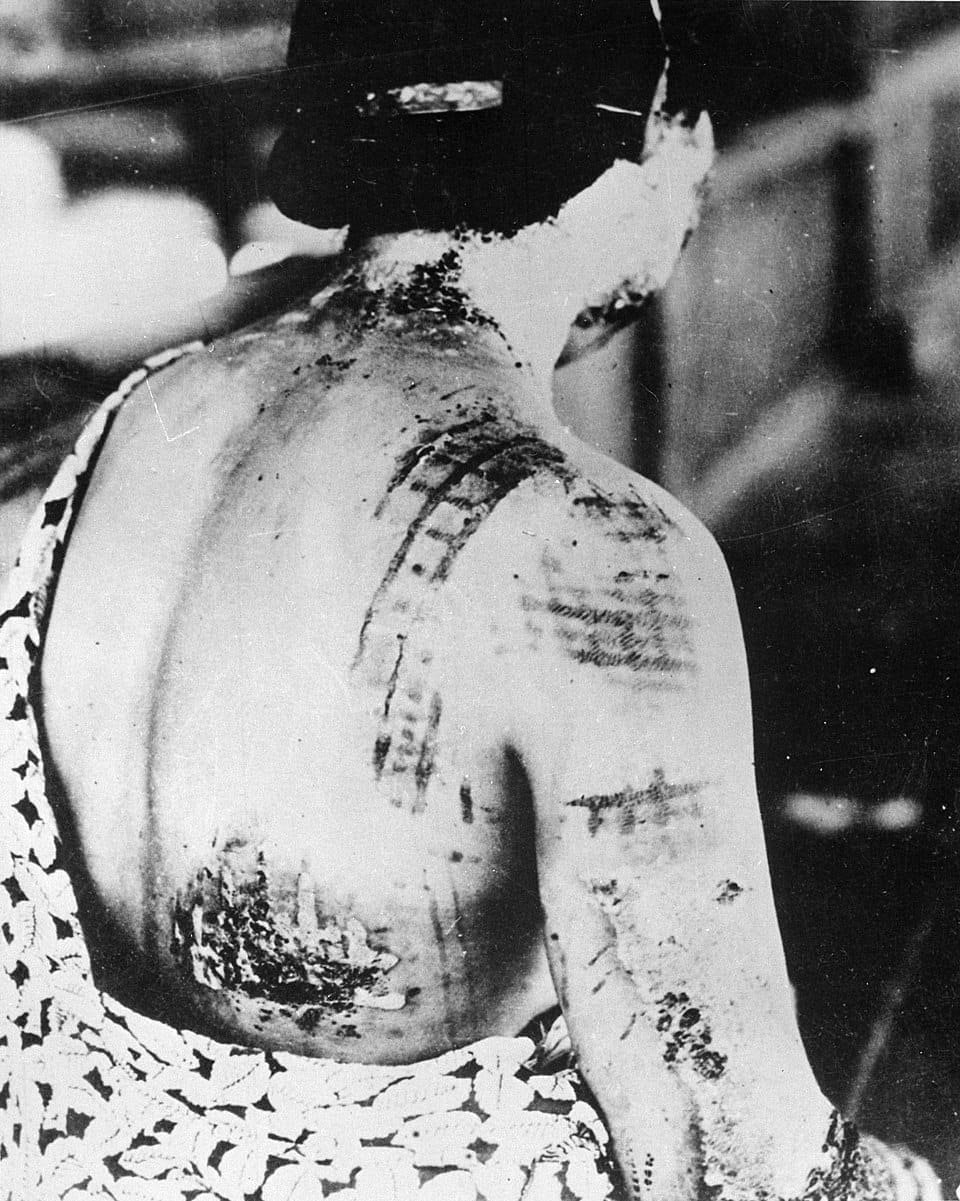 The pattern of the kimono worn by a survivor was burned into her skin in tight-fitting areas. Photo: Gonichi Kimura, Wikimedia Commons