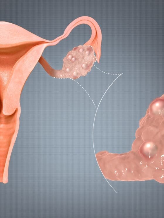 Polycystic Ovarian Syndrome: Symptoms and Treatment
