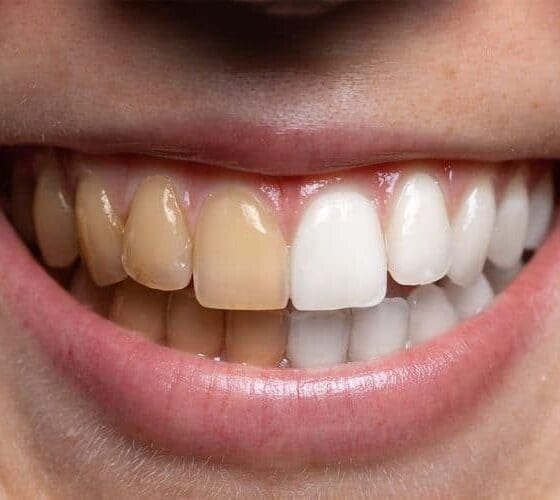 The Dark Side of Whitening Toothpaste: Risks & Safer Options
