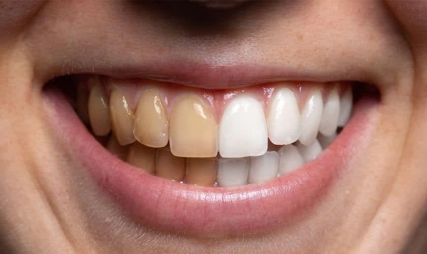 The Dark Side of Whitening Toothpaste: Risks & Safer Options