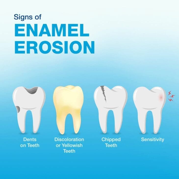 Close-up illustration of enamel erosion showing dents on teeth, yellowish discoloration, chipped enamel, and signs of sensitivity.